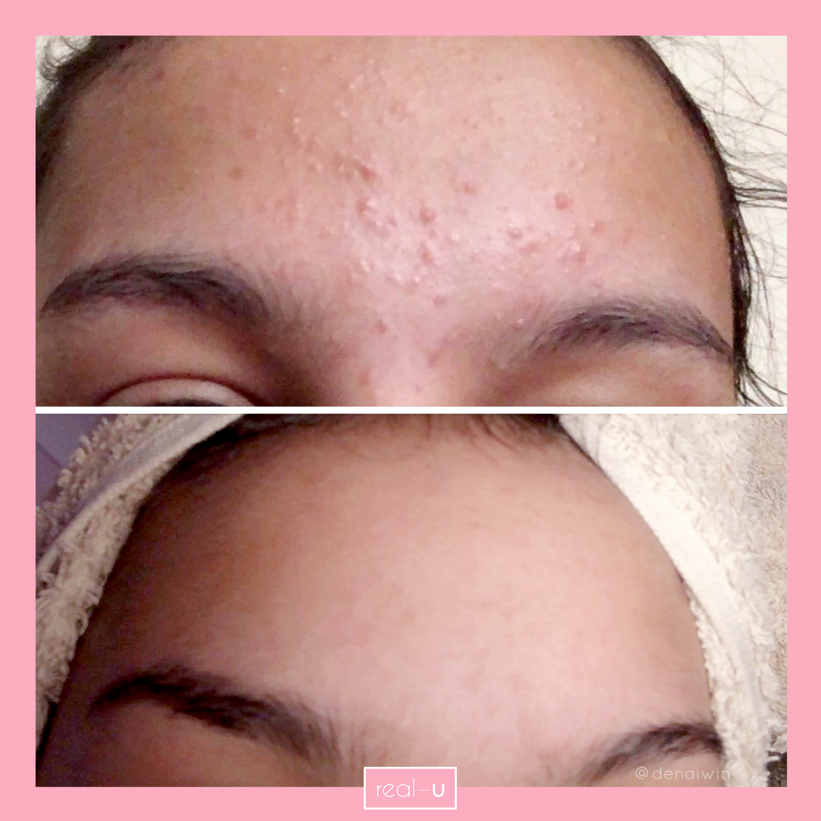 real-u before and after results with the green starter kit