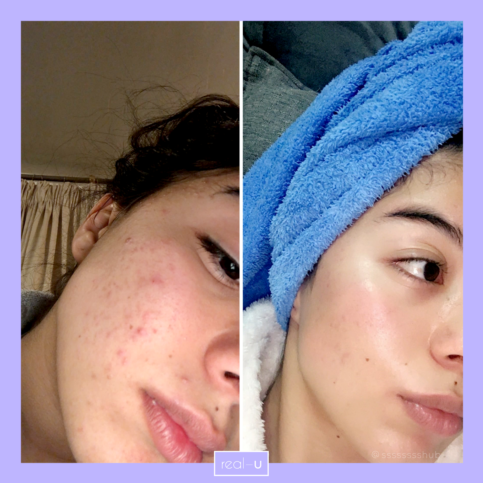 real-u before and after acne results with Green Luxe Kit