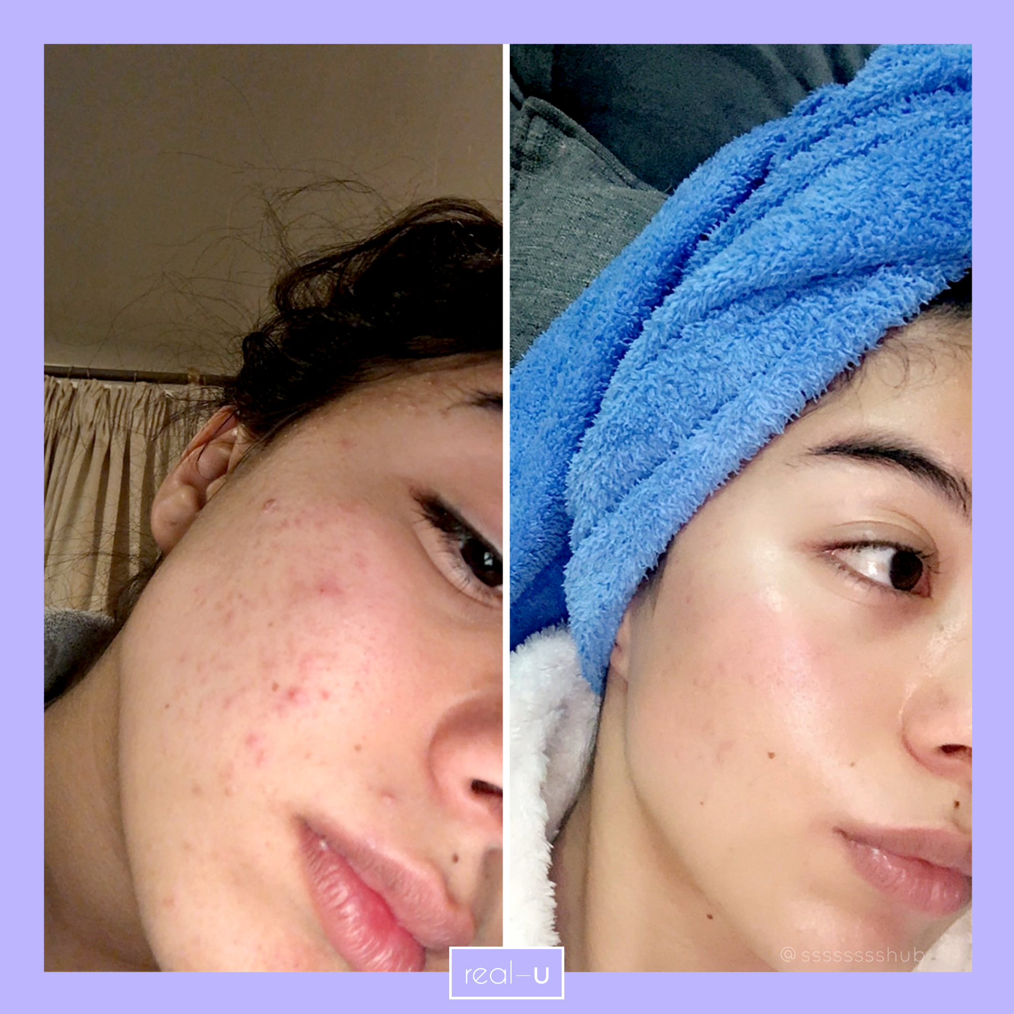 real-u before and after acne results with Green Luxe Kit