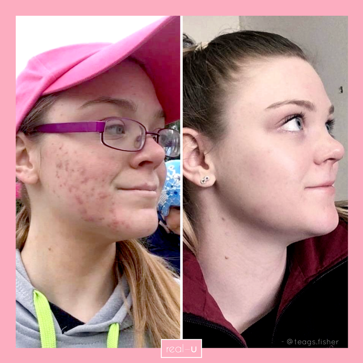 real-u before and after acne skincare pic