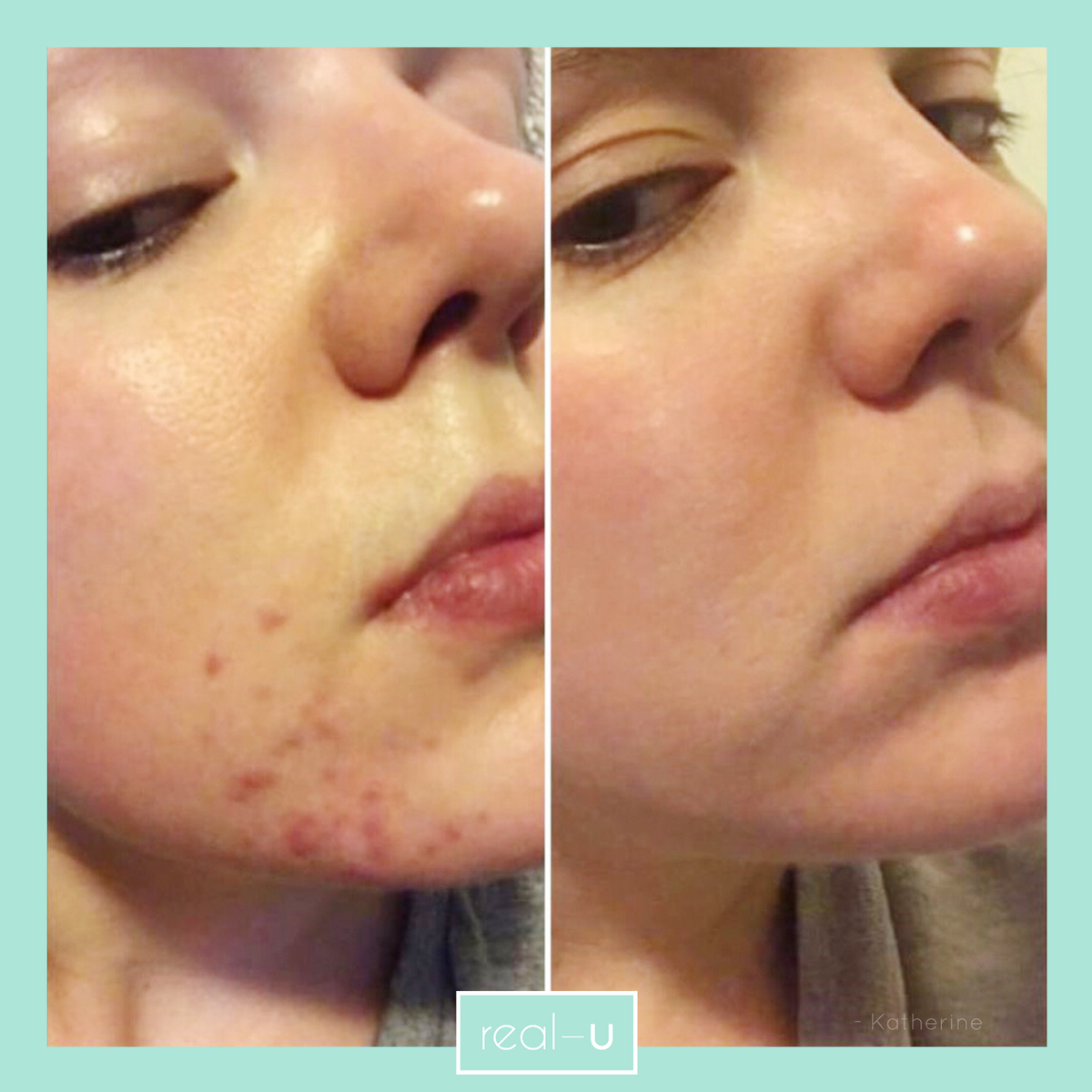 real-u acne skincare before and after pic