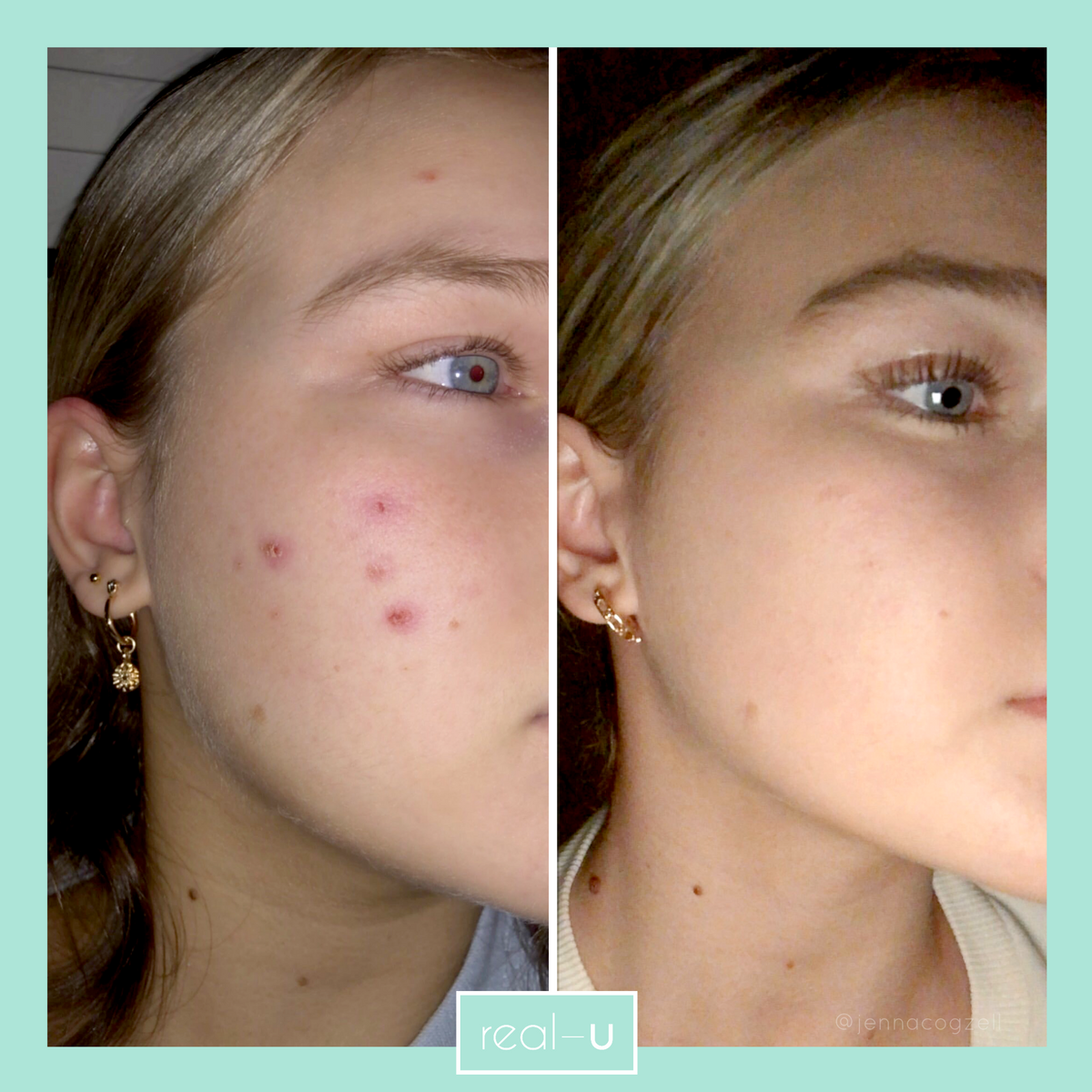 real-u acne skincare before and after results