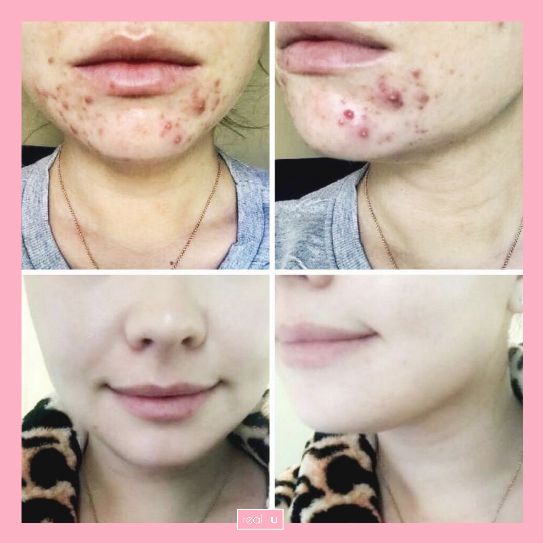 real-u before and after acne skincare pic