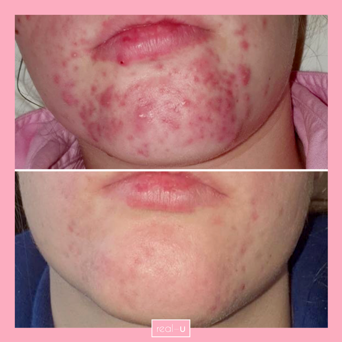 real-u before and after acne skincare results