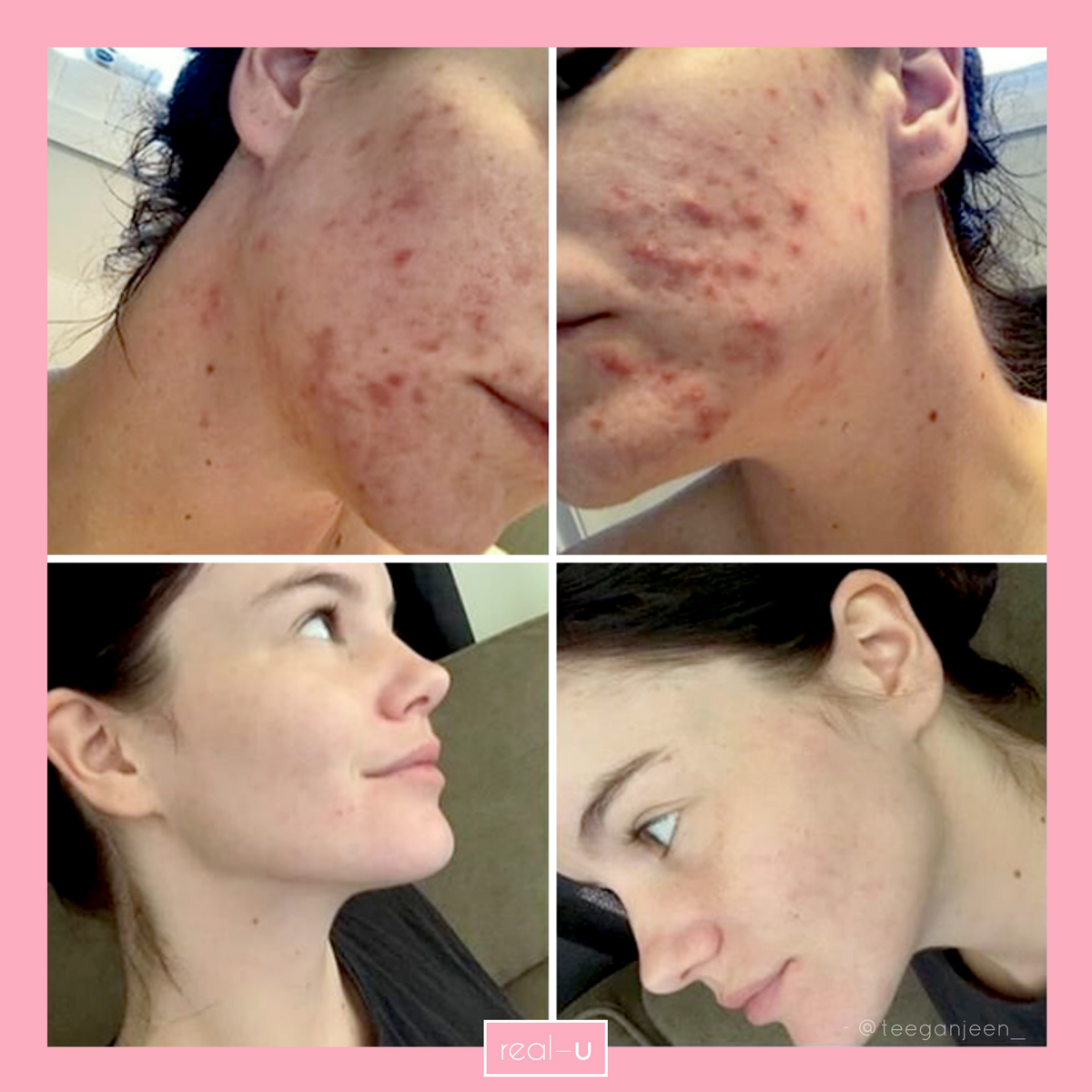 real-u acne skincare before and after result