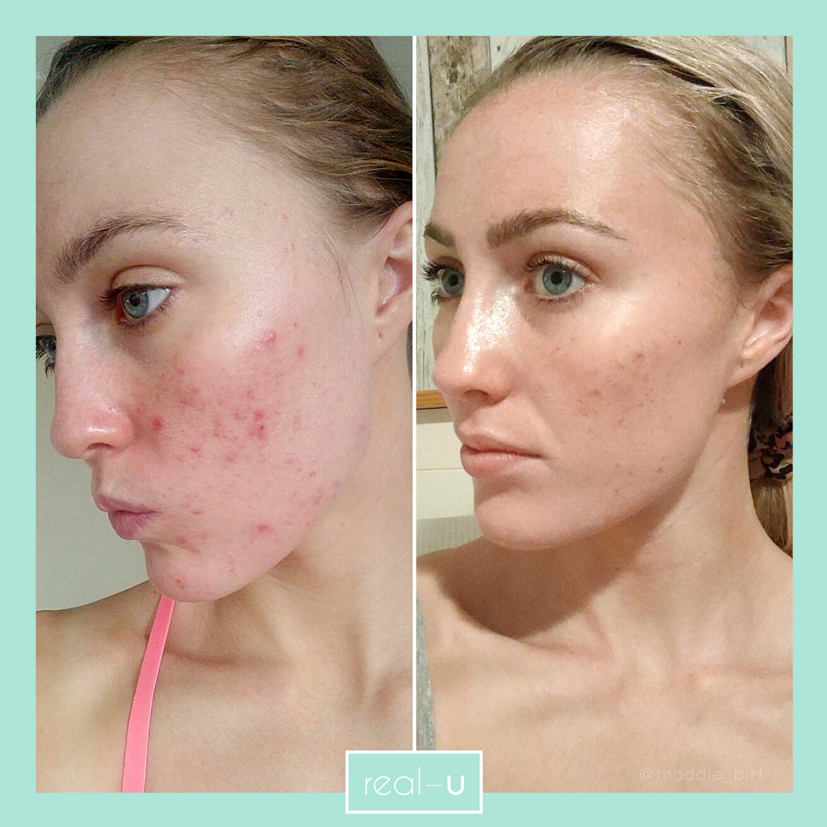 real-u acne skincare before and after results