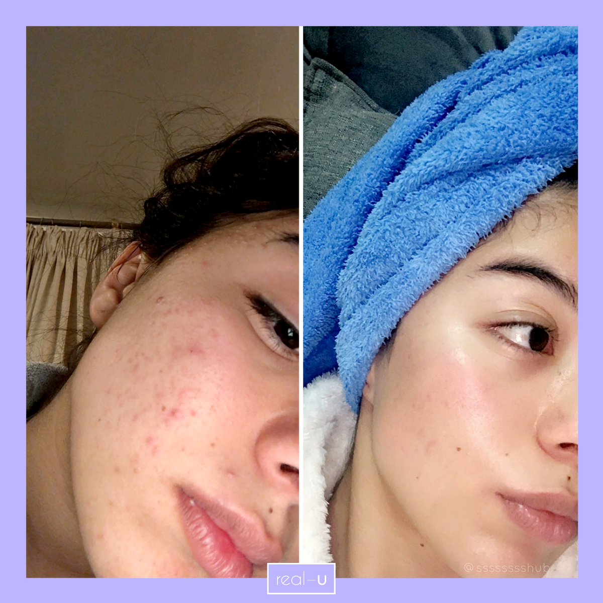 real-u acne before and after pic