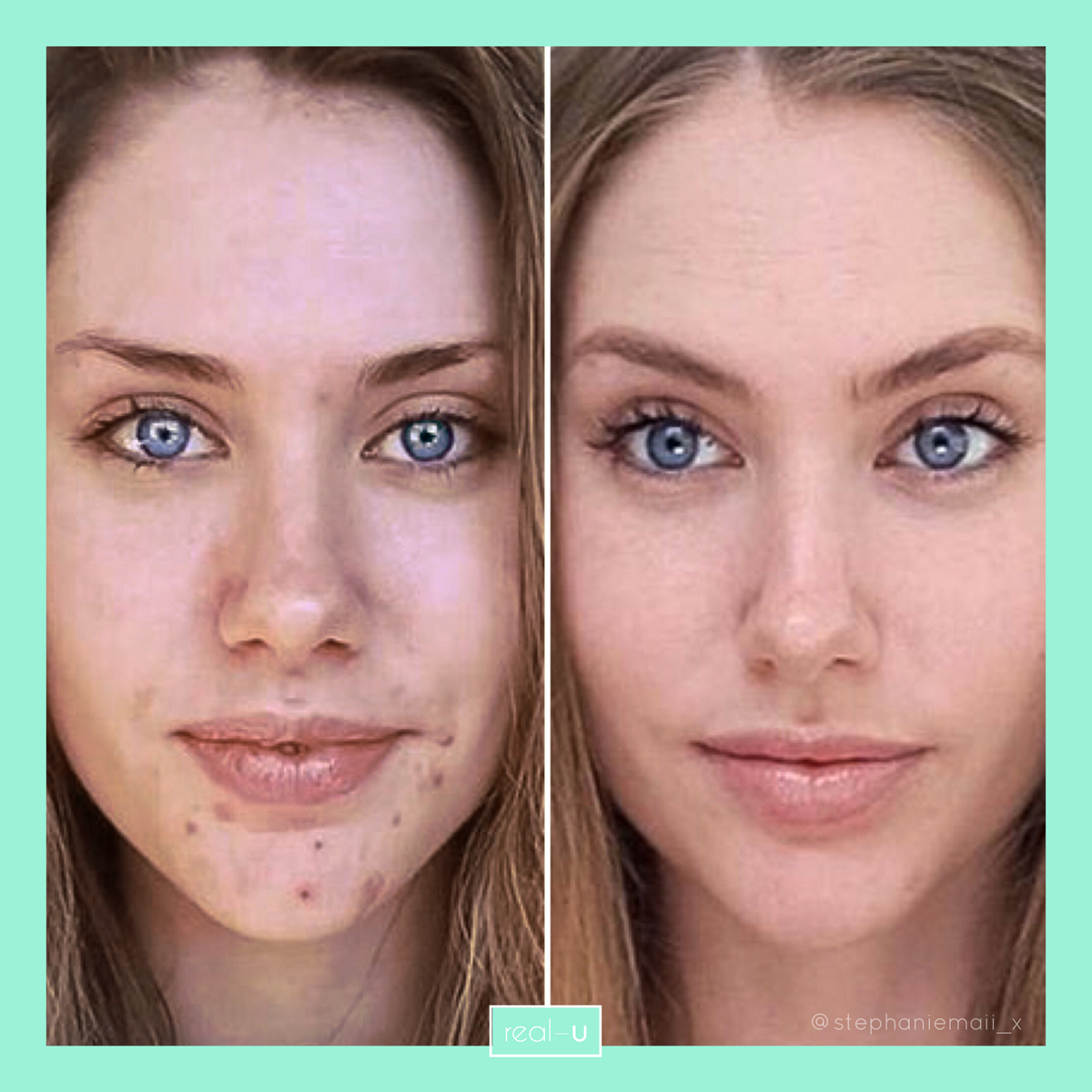 real-u acne skincare results 